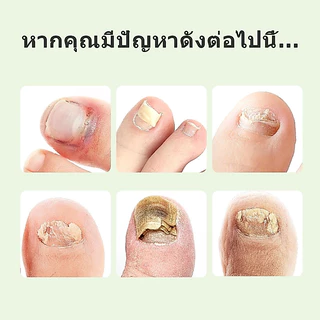 น้ำยาฟื้นฟูเล็บ น้ำยารักษาเชื้อราที่เล็บ เสริมความแข็งแรงและปกป้องเล็บที่เปราะบาง