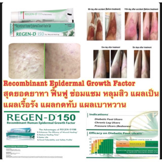 Regen-D EGF Cream ซ่อมแซม ฟื้นฟู หลุมสิว แผลเป็น แผลเรื้อรัง 15 g