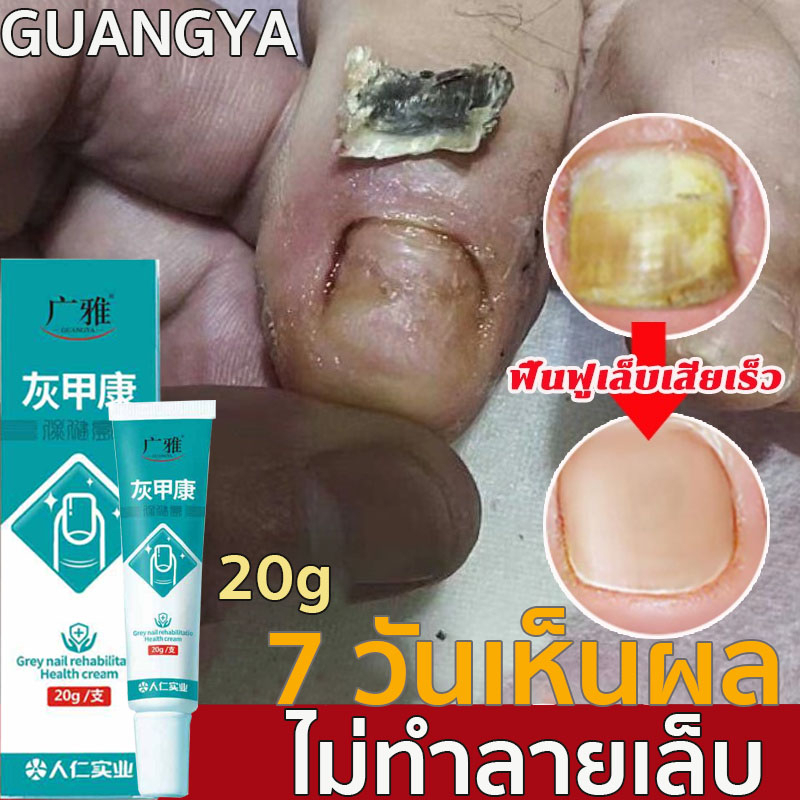 ยาฆ่าเชื้อราที่เล็บ 20ml ยาฆ่าเชื้อราเล็บเท้า ซ่อมแซมโรคเชื้อราที่เล็บ เล็บขบ น้ำยารักษาเล็บ nail fungus