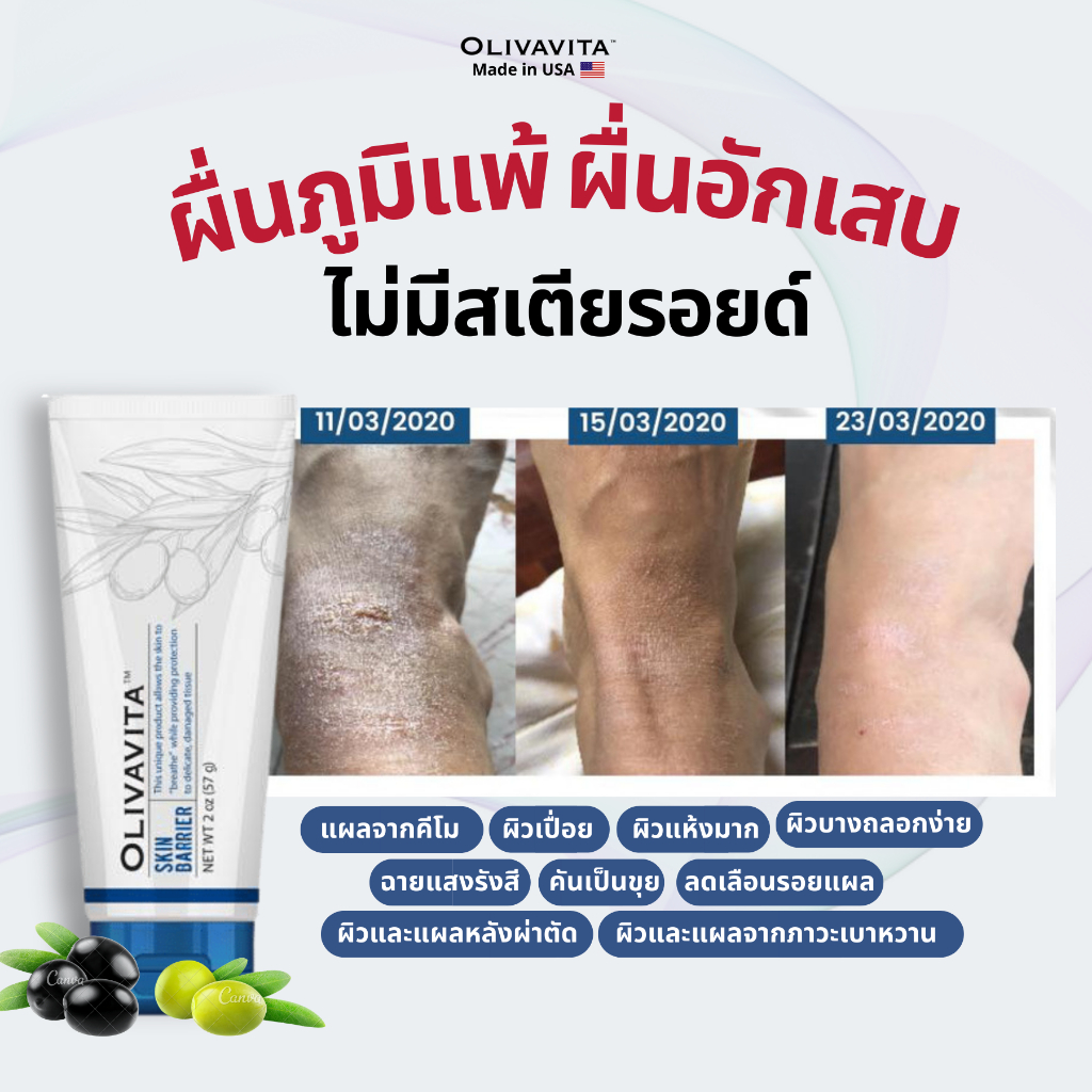 รักษาผื่นภูมิแพ้เรื้อรัง ผื่ผิวหนังอักเสบ แผลเบาหวาน แผลไหม้ สมานแผลผ่าตัดไม่ให้ทิ้งรอย สมานแผลโดยไม่ใช้สเตียรอยด์