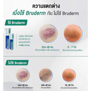 Bruderm ครีมลดรอยช้ำ ลดบวมอันดับ 1 exp.08/27