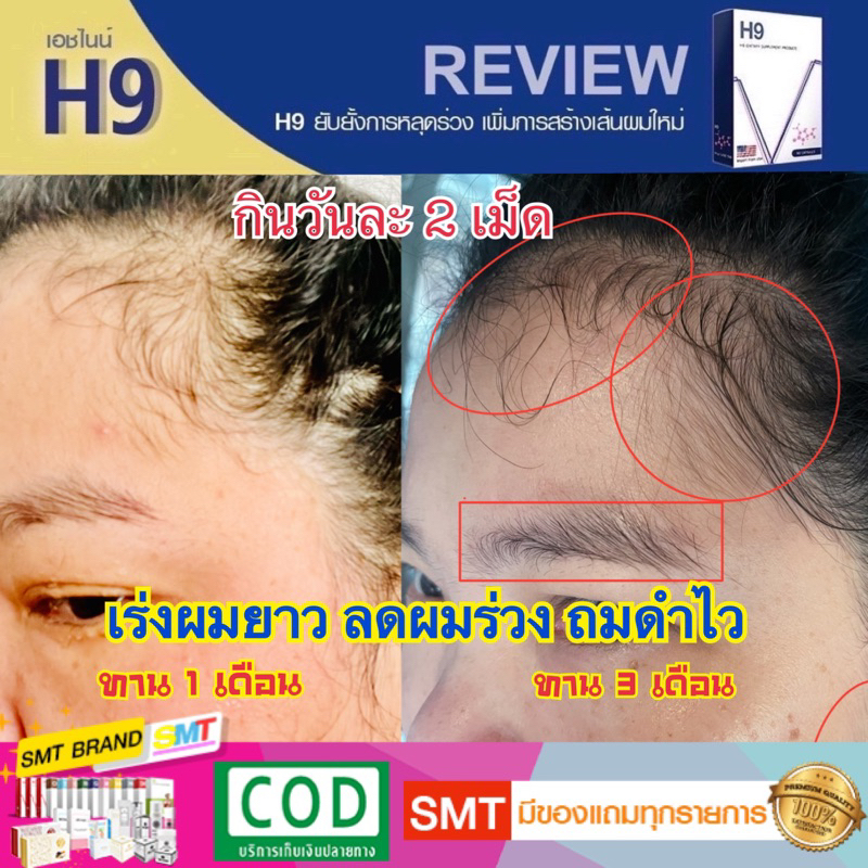 H9 วิตามินผมดก แบบทาน ลดผมร่วง เร่งผมยาว แบ่งขาย ไบโอติน 3000 ต่อเม็ด ยาแก้ผมร่วง - รูปที่ 5