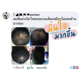 แชมพูพรทิน่า ✅ลดผมร่วง เร่งผมเกิดใหม่ บำรุงหนังศีรษะและเส้นผมให้ แข็งแรง