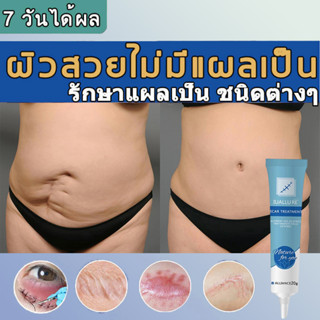 ครีมลดรอยแผลเป็น ยาทาแผลเป็น ครีมลดรอยแตกลาย 20g เด็กก็ใช้ได รอยสิว ลบรอยแผลเป็น สำหรับรอยสิว แผลเผาไหม้ ลดรอยแผลเป็น