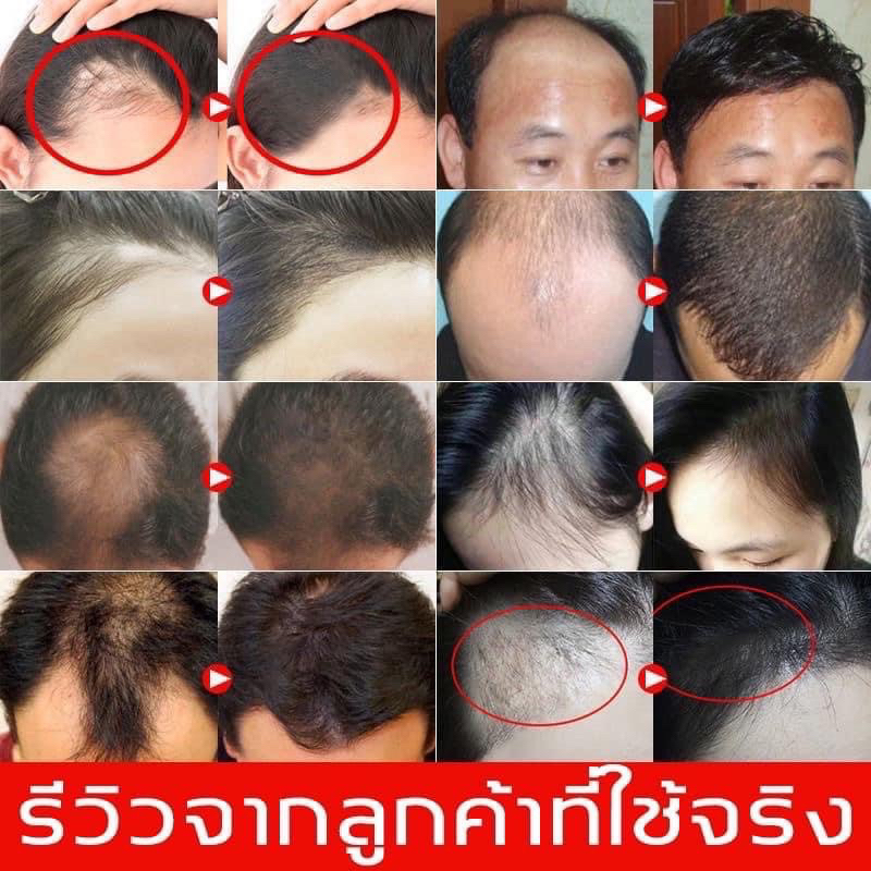 (1ขวด) เซรั่มปลูกผมสูตรเร่งด่วน จัดส่งไว ของแท้ - รูปที่ 2
