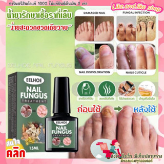 Eelhoe nail fungus น้ำยาบำรุงเล็บกำจัดเชื้อราที่เล็บ เล็บขบ เล็บปวด เชื้อราที่เล็บ