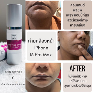 Skin Actives Clarifying Cream plus EGF ลดสิวทุกรุปแบบ ลดรอยสิว สมานแผล