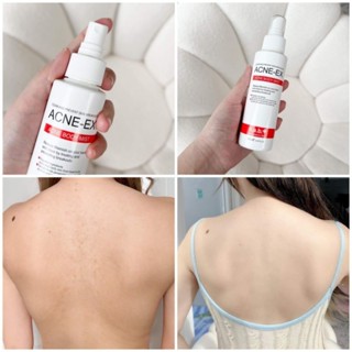 สเปรย์รักษาสิวตัวดัง ACNE-EX Body Spray ช่วยยับยั้งแบคทีเรีย สาเหตุของการเกิดสิว ช่วยให้สิวอักเสบแห้ง และยุบภายใน 24 ชม.