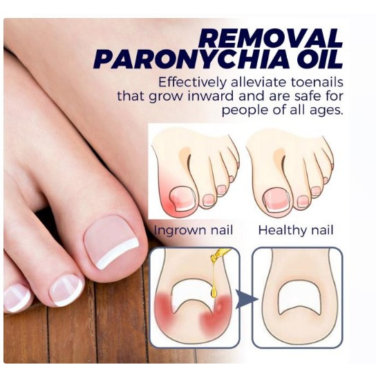 น้ำมันฆ่าเชื้อราที่เล็บลดปวดบวมอักเสบ Removal paronychia oil - รูปที่ 6