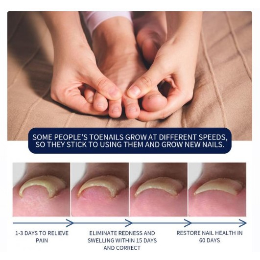 น้ำมันฆ่าเชื้อราที่เล็บลดปวดบวมอักเสบ Removal paronychia oil - รูปที่ 7