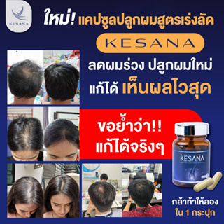 อาหารเสริมลดผมร่วง ปลูกผม (แพค 1 ขวด) เห็นผลทันใจ แก้ปัญหาศรีษะล้านผมบาง เคซาน่า Kesana