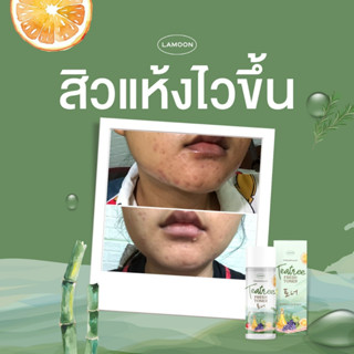 ❀ โทนเนอร์ทีทรีลดสิว สิวแห้งไว ขจัดแบคทีเรียที่ก่อให้เกิดสิว