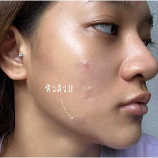 dermaAngel สิวอักเสบ มีหนอง รักษาสิว แผ่นแปะสิว Night (12 ชิ้น) 2 กล่อง