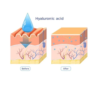 Brderm Hyaluron FILLER Matrix moist&firm บีอาร์เดิร์มไฺฮยาลูรอน 25 มิล
