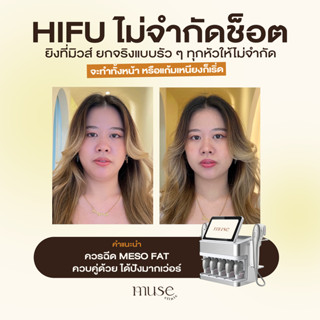 [E-Voucher] MUSE CLINIC : Promotion Ultra lift 7D Hifu ไม่จำกัด shots