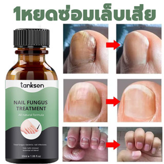 เซรั่มบำรุงเล็บ 30ml ซ่อมเล็บที่ชำรุด ฆ่าเชื้อราที่เล็บ ยาเชื้อราเล็บ เชื้อราเล็บ ยาฆ่าเชื้อราเล็บ เซรั่มรักษาเล็บ