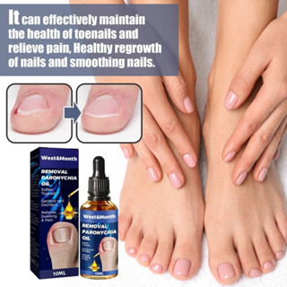 Removal paronychia oil น้ำมันฆ่าเชื้อราที่เล็บลดปวดบวมอักเสบ