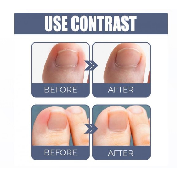 น้ำมันฆ่าเชื้อราที่เล็บลดปวดบวมอักเสบ Removal paronychia oil - รูปที่ 4