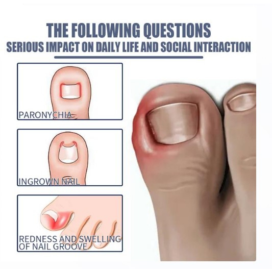 น้ำมันฆ่าเชื้อราที่เล็บลดปวดบวมอักเสบ Removal paronychia oil - รูปที่ 2