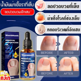 Removal paronychia oil น้ำมันฆ่าเชื้อราที่เล็บ แก้อาการปวดและบวม