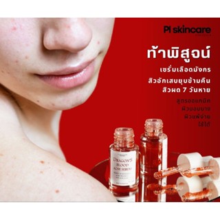 Dragons Blood Acne Serum เซรั่มเลือดมังกร ปราบทุกสิว สิวยุบไม่ทิ้งรอย หน้ากระจ่างใส