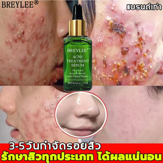 BREYLEEเซรั่มลดสิว17mlครีมกำจัดสิว ลดเลือนรอยสิว ครีมแต้มสิว ครีมลดสิว ครีมรักษาสิว รักษาสิว เจลรักษาสิว สิวอักเสบ สิวอุ