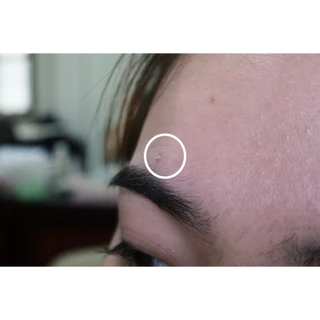 dermaAngel Salicyilc Acne patch for Day 12 ชิ้น 2 กล่อง