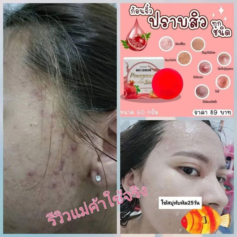 สบู่ทับทิม หมู่ไวท์ ลดสิว ผิวหมองคล้ำ thumbnail 7