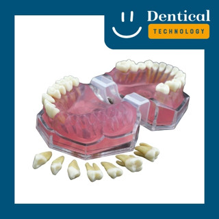 โมเดลฟันรุ่นพิเศษ (Soft Gum Dentoform)