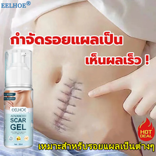 EELHOE ครีมลดรอยแผลเป็น ​50ml ลบรอยสิว รอยแผลเป็น จุดด่างดำ หมองคล้ำ ลดผิวแตกลาย ลบรอยแผลเป็น Scar Gel