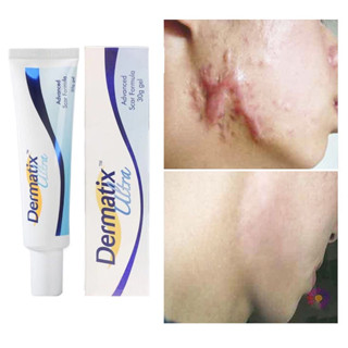 Dermatix Ultra Gelscar Repair ครีมบํารุงผิว ลดรอยแผลเป็น 0.5 ออนซ์ สําหรับผู้ชาย และผู้หญิง