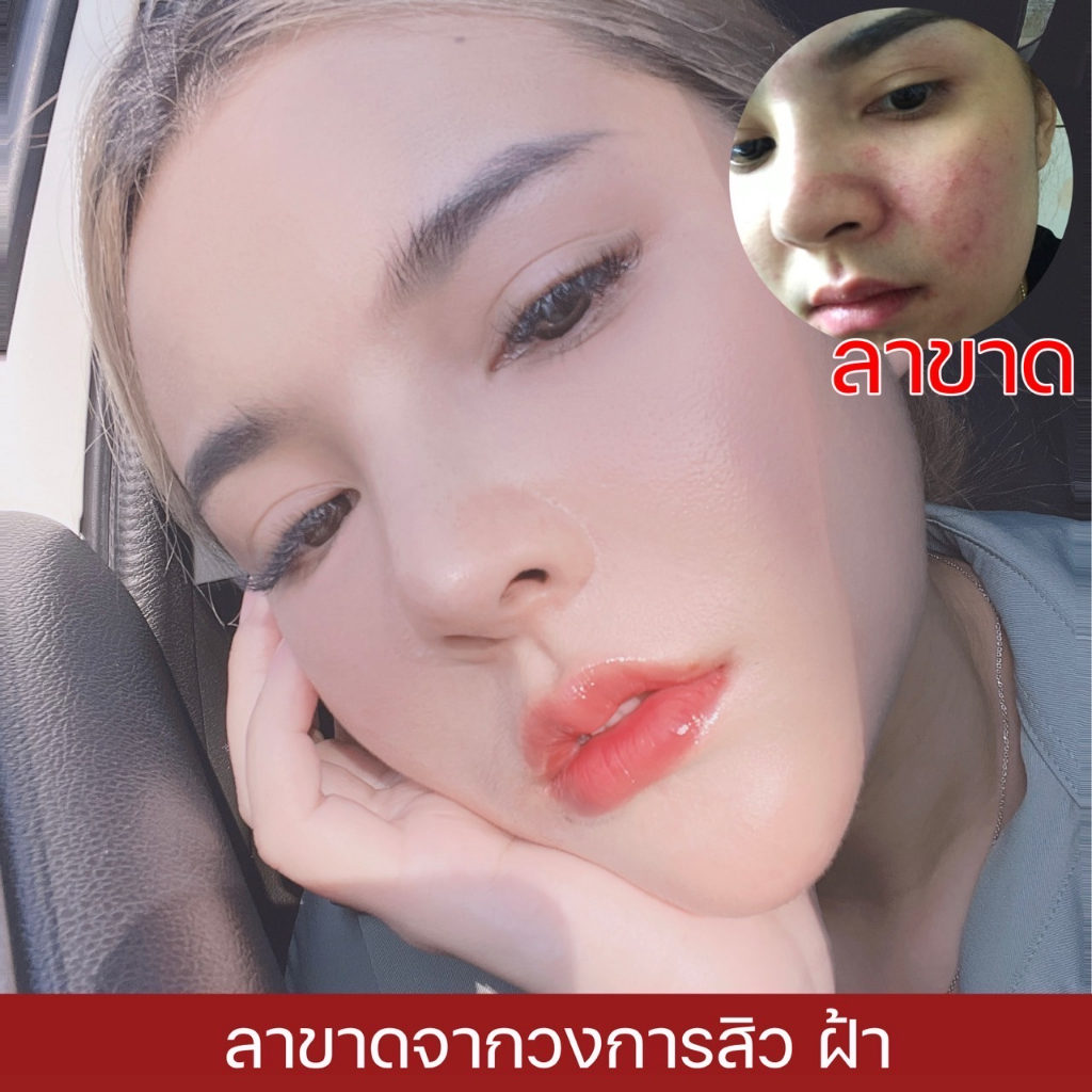 ALINN ครีมอลิน ครีมก่อนนอน บำรุงหน้า รักษาสิว ฝ้า กระ ผิวนุ่ม รอยดำ หน้ากระจ่างใส ปลอดภัย ของแท้100%