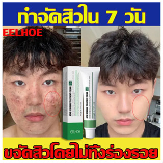 กำจัดสิว 20ML ลดสิวเสี้ยนครีมรักษาสิว สลายสิวอุดตันที่ต้นตอ อ่อนโยนและไม่ระคาย ครีมลดสิว ครีมกำจัดสิว เจลแต้มสิว