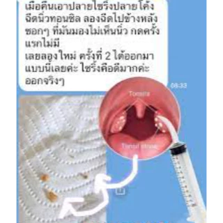 ไซริ้งค์ปลายโค้ง2ชิ้น กำจัดนิ่วทอนซิล ไซริ้งฉีดฟันคุด 🔥ถูกที่สุด🔥 พร้อมส่งจากไทย