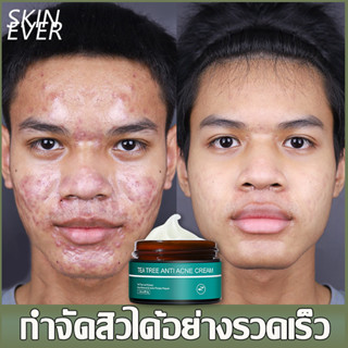 เห็นผลภายใน7 วันครีมกำจัดสิว ลดสิวถาวร ซ่อมแซมรอยสิว ลบสิวโดยไม่ทิ้งรอย(เจลแต้มสิว เจลรักษาสิว ครีมลดรอยสิว ครีมรักษาสิว