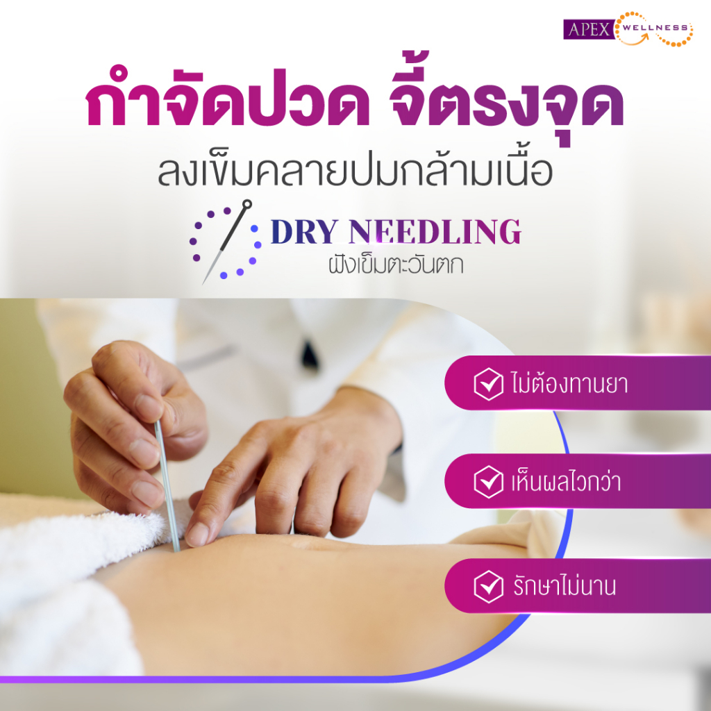[E-Voucher] APEX โปรแกรมฝังเข็มตะวันตก Dry Needling ลดอาการปวด ตึง เกร็ง ของกล้ามเนื้อ เลือก 1 จุด
