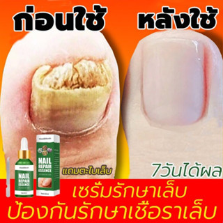 ของแท้100%ฆ่าเชื้อราที่เล็บ ซรั่มรักษาเล็บ ซ่อมเล็บที่ชำรุด เชื้อราเล็บ ครีมบำรุงเล็บ ยาฆ่าเชื้อราเล็บ น้ำยารักษาเชื้อรา