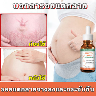 ลดรอยแตกลาย TONISABERY ครีมทาท้อง 30ml รอยแตกลาย ท้องลาย ครีมทาท้องลาย ลายขาว ท้องแตกลาย รอยแผลเป็น ลายแดง