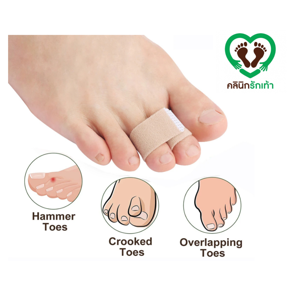 Lovefootplus เฝือกพันนิ้วเท้า เพื่อพักนิ้วเท้า
