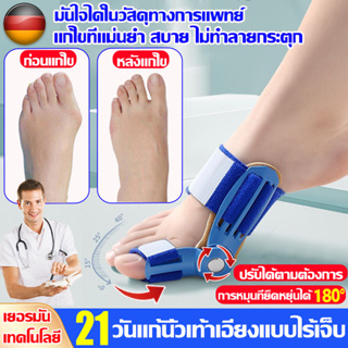 Hallux valgus เทคนิคเยอรมัน วัตถุทางการแพทย์ อุปกรณ์แก้ไขเท้าผิดรูป ดัดกระดูกนิ้วโป้งเท้ายื่น โปน นิ้วหัวแม่เท้าเอียง