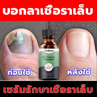 💅TanKsen ยารักษาเชื้อราเล็บ ยาทาเชื้อราเล็บ เชื้อราที่เล็บซ่อมแซมโรคเชื้อราที่เล็บ น้ำยารักษาเล็บ ยาฆ่าเชื้อราที่เล็บ