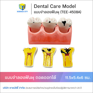 แบบจำลองฟันผุ ถอดออกได้ (7ชิ้นส่วน)