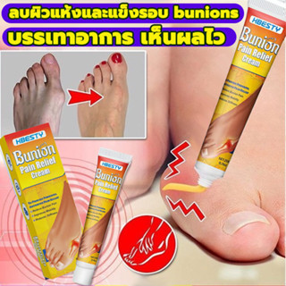 Bunion cream ลดปวด ลดอักเสบ นิ้วโป้งโค้งงอเข้า Hallux valgus ปวดเท้า ปวดข้อ ปวดบวม ข้ออักเสบ ข้อบวม ข้อต่อนิ้วเท้า
