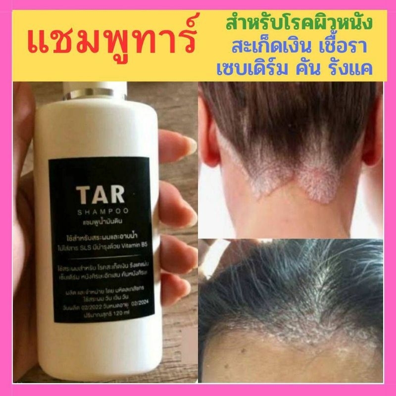 Tar Shampoo ทาร์แชมพู แชมพูรสำหรับโรคผิวหนัง แชมพูสำหรับสะเก็ดเงิน เชื้อรา เซบเดิร์ม อาการคัน รังแค (120 มล.)แชมพูทาร์