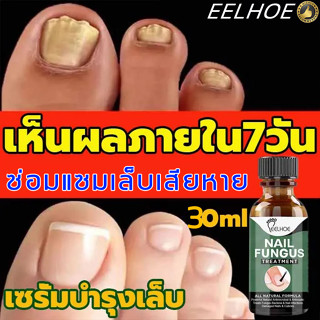 【 เซรั่มรักษาเล็บพัง เล็บหลุดลอ 】EELHOE เซรั่มรักษาเล็บ เชื้อราที่เล็บ ซ่อมแซมเล็บ ฆ่าเชื้อราที่เล็บ ฆ่าเชื้อราที่เล็บ ร