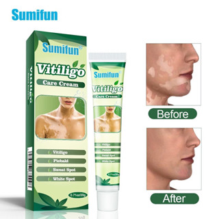 ขายดี อันดับ 1 ครีม Sumifun Vitiligo ดูแลผิวด่างขาว