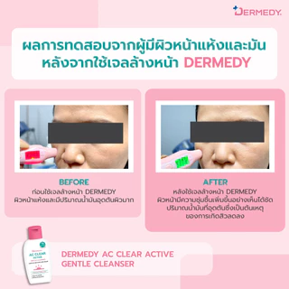 DERMEDY AC CLEAR ACTIVE GENTLE CLEANSER (BOTTLE) เดอร์มีดี เอซี เคลียร์ แอคทีฟ เจนเทิล คลีนเซอร์