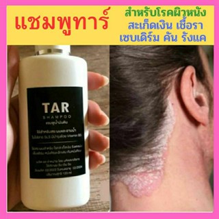 ☘️Tar Shampoo ทาร์ แชมพูสำหรับโรคผิวหนัง โรคสะเก็ดเงิน เชื้อรา คัน เซบเดิร์ม☘️