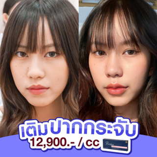 [E-voucher] ฟิลเลอร์ปากสวีเดน รุ่น KYSSE ปั้นทรงปากสวยจึ้งสุด พิเศษ 2 cc ลด 1,000.- MEGA CLINIC เมกะคลินิก