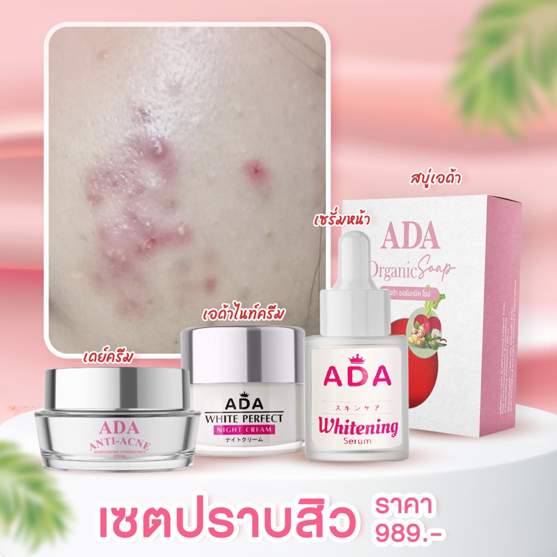 (ส่งฟรี) Nok.ADA Official: เซ็ตสำหรับรักษาสิวเอด้า